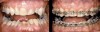 Figure 14  Initial and treatment photographs of the patient seen in Figure 13. The mandibular anterior teeth have been built up and then orthodontically intruded, creating space for restoration.