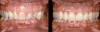 Figure 15  Before and after photographs of the patient seen in Figures 13 and 14. The patient was treated with orthodontics and four maxillary incisors and four mandibular incisor full crowns. No changes were made to the patient’s vertical dimension.