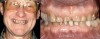 Figure 16   The initial presentation of a 65-year-old man with severe anterior tooth wear desiring esthetic improvement.
