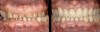 Figure 21  These before and after photographs appear to show a significant increase in vertical dimension; however, the maxillary anterior teeth have had 4 mm to 5 mm of periodontal crown lengthening. Although this patient’s entire mouth was reconstructed at once, the vertical dimension was increased only 1.5 mm because the patient already had excessive overjet.