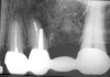 Figure 2  Post space created off-line from root canal creating a root perforation.