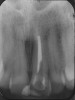 Figure 4  Take verifying radiographs to check on gutta- percha removal and length of post space desired.