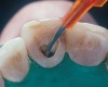 Figure 5  Placement of a resin cement into a root canal before post placement.