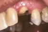 Figure 6b  Central incisor after crown fracture. This was not an endodontically treated tooth.