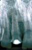 Figure 7  Immature central incisor fractured before completion of apexification. Note the enlarged, immature root canal.