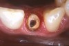 Figure 8a  Enlarged root canal with thin dentin root canal walls.