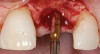 Figure 5  Crestal contour with core biopsy.