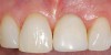 Figure 7  Provisional crown, 3 months after placement.