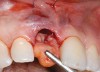 Figure 19  Connective tissue graft introduced via extraction socket.