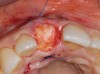 Figure 21  Completed socket graft with connective tissue graft.