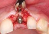 Figure 31  Stage I surgery. Note the regenerated labial plate.