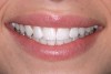 Figure 2  1:3 full smile photograph.