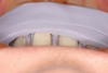 Figure 15  Reduction stents can be made to help ensure proper 3-plane reduction of maxillary anterior teeth. Under-reduction of the incisal third will often lead to edges too far to the facial. The laboratory becomes limited, and is forced to produce an over-contoured restoration.