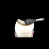 Figure 2  The occlusal surface of the tooth is reduced to provide 2 mm of porcelain thickness in the definitive restoration.
