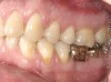 Figure 1  The crown height is measured from the alveolar crest to the occlusal table.