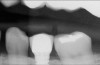 Figure 2  Vertical components of crown height space for a cement-retained restoration.