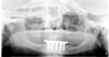 Figure 9  Vertical components of crown height space for a bar-retained implant overdenture.