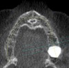 Figure 7  Six-month post-graft CBCT axial view showing substantial bone growth from graft.