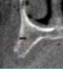 Figure 8  Six-month post-graft CBCT cross-sectional view showing 5 mm of bone growth vertically.