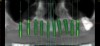 Figure 10  Post-graft panographic view showing plan for implant placement.
