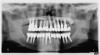 Figure 12  Post-placement panographic revealing implant positions.