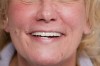 Figure 13  Clinical view of the patient’s smile revealing final fixed prosthesis on maxillary implants.