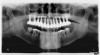 Figure 24  Panographic view 1 year post-implant placement.