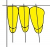 Figure 25  Schematics (25.) Mesio-distal inclinations of the mandibular anterior teeth and incisal position after adjustment to maintain "kissing contact" (in excursive movements).