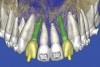 Figure 19  SOFTWARE IMAGING By using the virtual teeth feature, final implant and abutment positioning was checked.