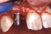 Figure 36  VIRTUAL PLANNING AND SURGERY By predetermining the necessary orientation of the restorative components, the implant’s antirotational hex was positioned correctly.