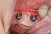 Figure 11  Note the absence of bone at the facial surface of the implants. A hard-tissue graft should be considered.