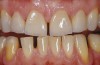 Figure 1a  Clinical situation after the placement of four bonded porcelain restorations (veneer type) on the four vital maxillary incisors, rehabilitating not only esthetics but also function and mechanical integrity of anterior teeth.