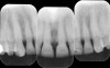 Figure 1d  The 1-year follow-up radiographs show perfectly stable situation.
