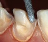 Figure 2b  Clinical situation during preparation of the  eroded teeth. Existing restorations, as well  as severe initial erosion and wear, led to the  realization of a shoulder facial preparation.