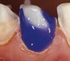 Figure 2d  Immediately after tooth  preparation, the uncontaminated dentin surfaces  are etched for 5 to 15 seconds (depending  on the adhesive system used). It is  recommended to extend etching 1 mm to 2  mm over the remaining enamel to ensure  further adhesion of eventual excess resin.