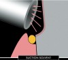 Figure 2j  The dentin surface is  suctioned again to eliminate the solvent from  the priming solution.