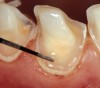 Figure 2k  The adhesive is applied  with precision using a drop of resin on  the tip of a periodontal probe. Direct contact  between the dentin and the tip of the probe  should be avoided. The probe is used to  help spread the adhesive to the edges of  the exposed dentin.
