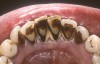 Figure 4a  Periodontally compromised mandibular incisors treatment planned for splinting with an adhesive fiber-reinforced composite resin.