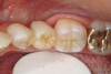 Figure 7  The completed 3-unit fiber-reinforced resin FPD replacing the mandibular second premolar.