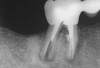 Figure 1a  Mandibular first molar with distal root fracture. Note the root canal perforation and post in the mesial root.