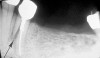 Figure 1b  Mandibular second premolar with a short, large-diameter post that has created a vertical root fracture.