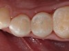 Figure 20  Postoperative view of the completed posterior restorations.