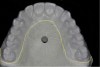 Figure 1  Occlusal view of a 0.020 vacuum form material on the study model. The cut-out pattern is marked in yellow.
