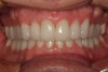 Figure 23  A 1-year follow-up of the completed maxillary and mandibular reconstruction cemented with self-etching resin cement. Occlusal stability and gingival health have been achieved and maintained.