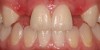 Figure 5a  Congenitally missing lateral incisors. Postorthodontic therapy, prior to implant placement.