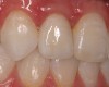 Figure 5e  Completed, porcelain-fused-to-gold implant restorations, custom gold abutments, lingual-set screw-retention, Kerr Extrude¬Æ light-body crown-abutment seal.