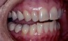 Figure 3  Note the sign of instability associated with tooth No. 27. The tooth has insufficient contour to provide adequate canine guidance.