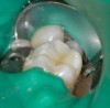 Figure 6   The final restoration, ready to be shaped and polished. Note the subtle occlusal stain.