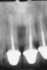 Figure 2  Crown lengthening should be avoided if there is caries under a crown in the esthetic zone because it will result in recession and an unesthetic appearance.