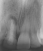 Figure 3   Teeth with periapical lesions > 5 mm should be considered for extraction in the esthetic zone.
